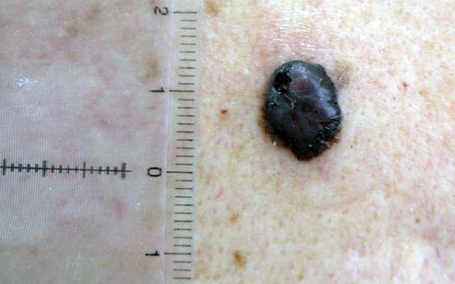 Raspored besplatnih pregleda ranog otkrivanja melanoma za oujak